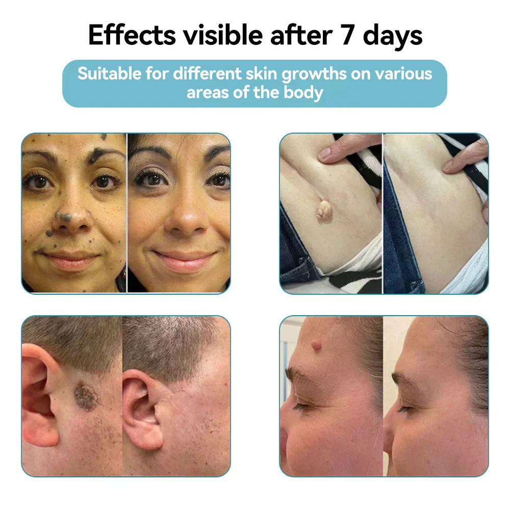 DermaBeam Pro – Erase Skin Flaws Instantly + 50% OFF
