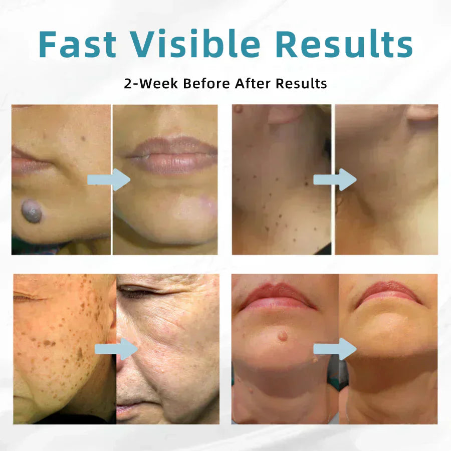 DermaBeam Pro – Erase Skin Flaws Instantly + 50% OFF