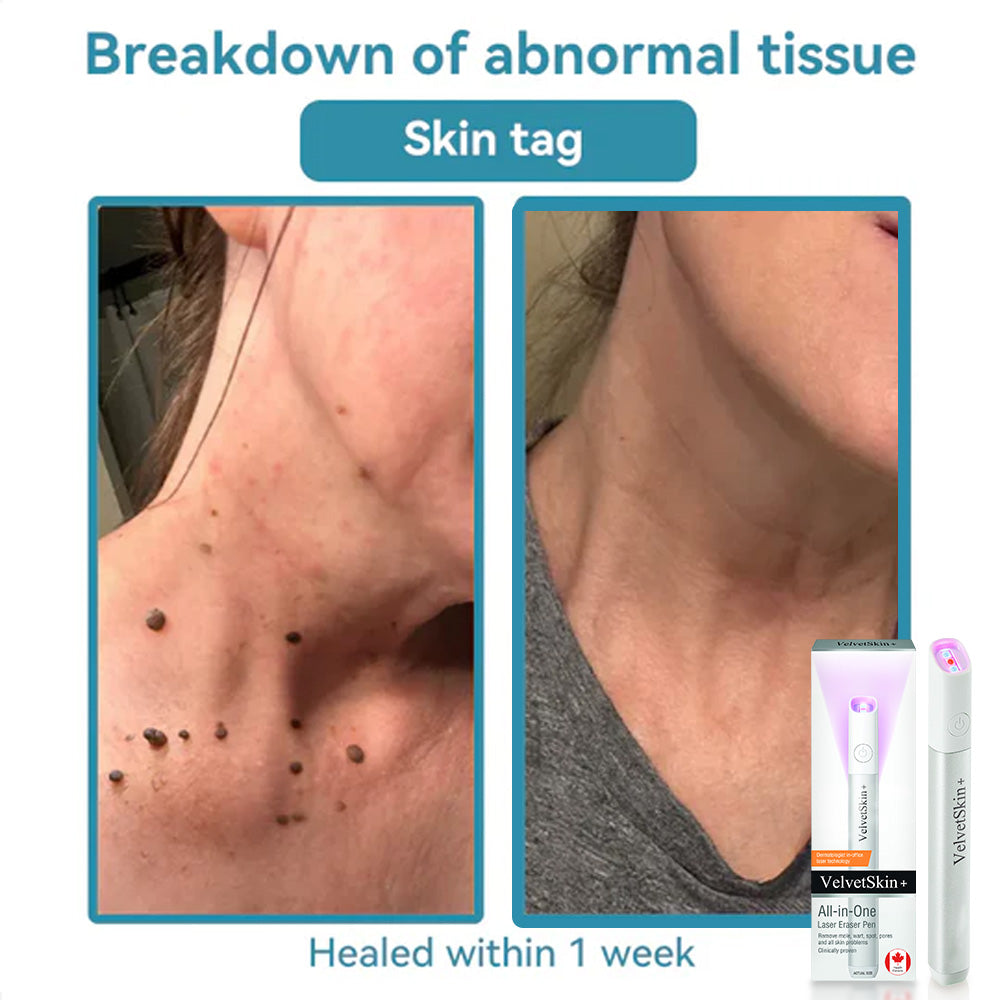 DermaBeam Pro – Erase Skin Flaws Instantly + 50% OFF