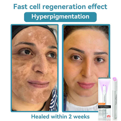 DermaBeam Pro – Erase Skin Flaws Instantly + 50% OFF