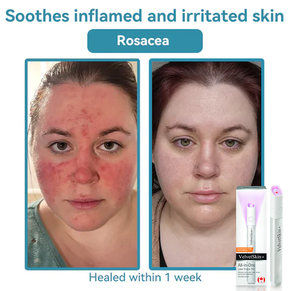 DermaBeam Pro – Erase Skin Flaws Instantly + 50% OFF